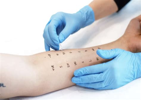 skin prick test